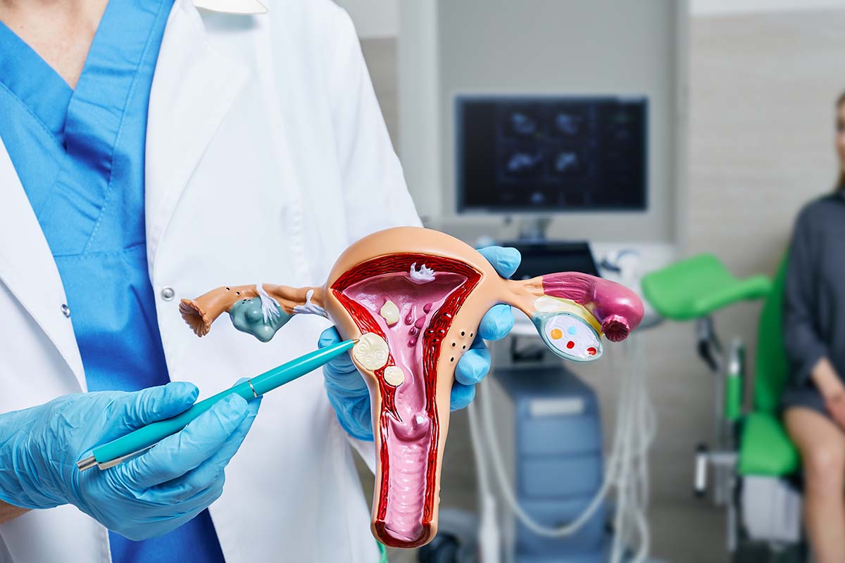 Fibroids: Symptoms, Diagnosis, and Treatment Options